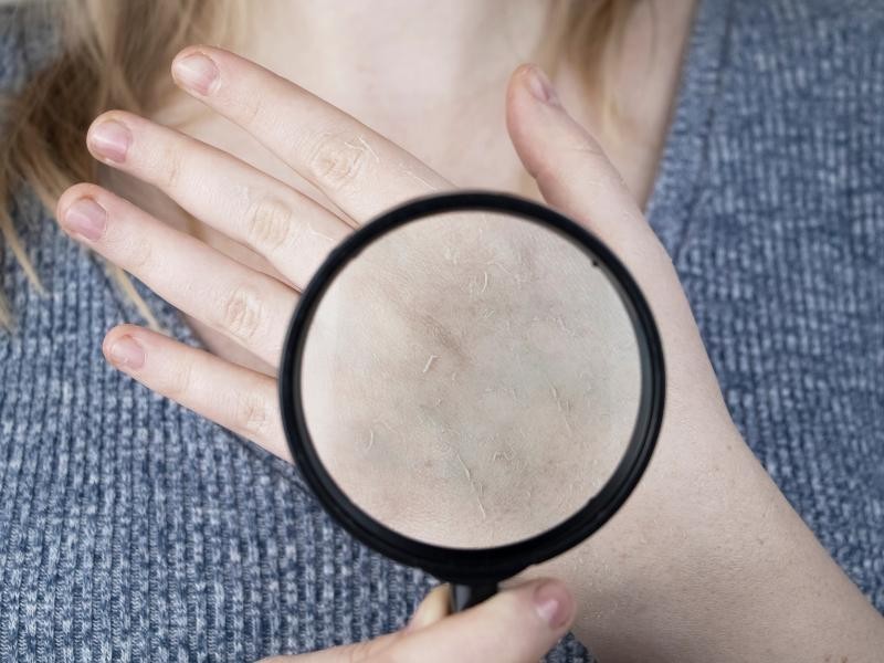 Micose de Pele: Tipos Mais Comuns, Tratamentos e Como Prevenir