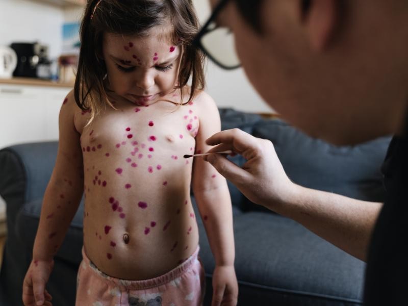 Catapora em Adultos e Crianças: Por que ainda se prevenir é essencial